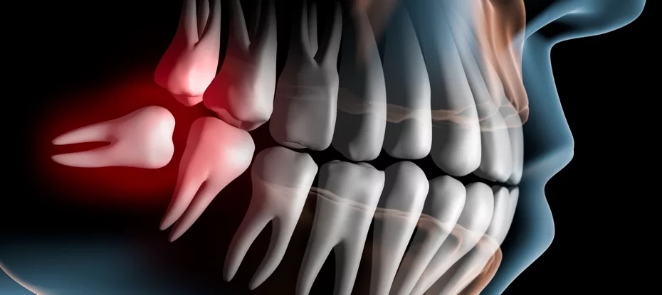 Por que os humanos têm dentes do siso?