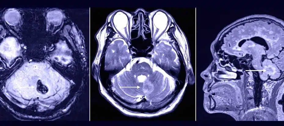Visita ao dentista pode ter desencadeado sangramento cerebral raro em paciente